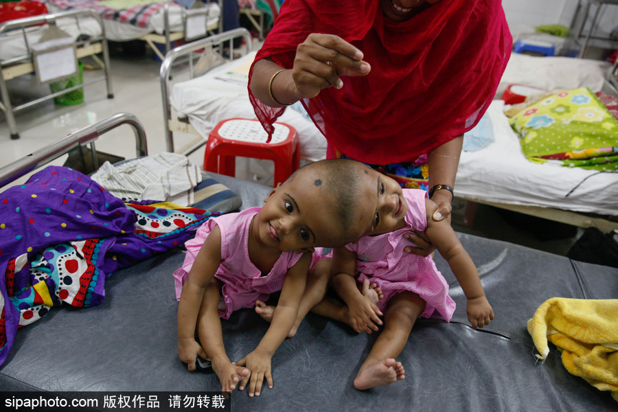 孟加拉國連頭嬰兒 至少到兩歲才能進(jìn)行手術(shù)